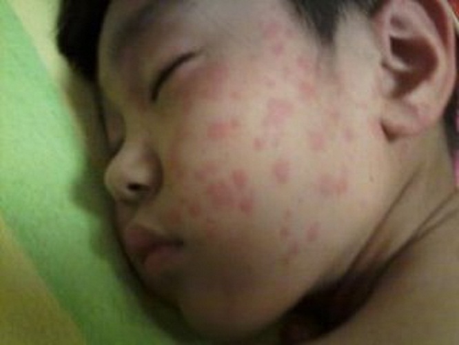 丘疹性荨麻疹传染吗图片
