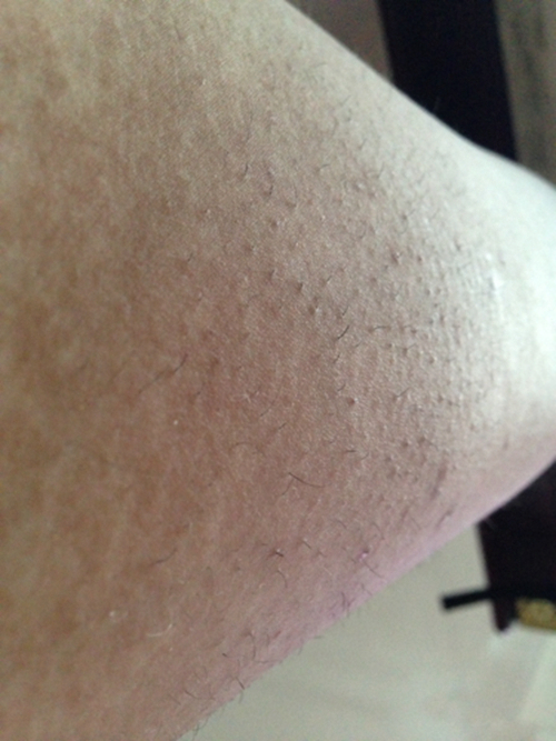 冬季皮肤干燥毛囊炎图片