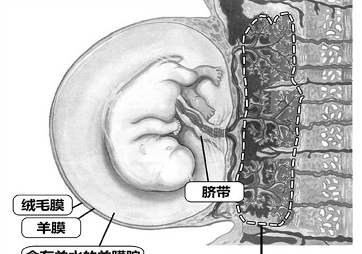 妊娠合并梅毒的胎盘图