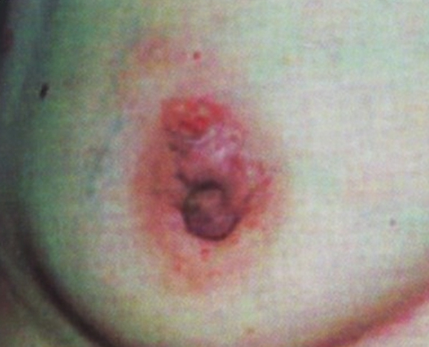 乳房初期淋巴结肿大图片