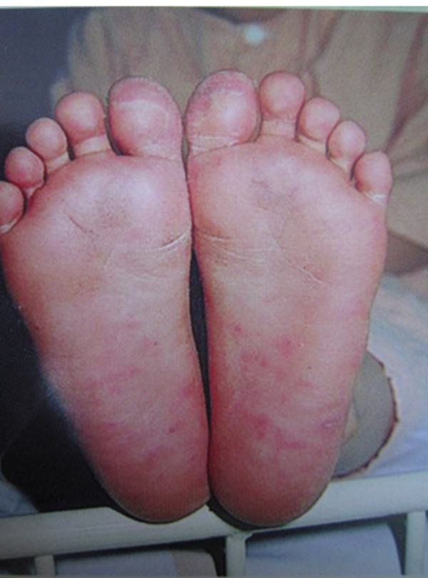 手足口病初期症状图片 早期_非典型手足口初期症状_手足口症状图片 初期