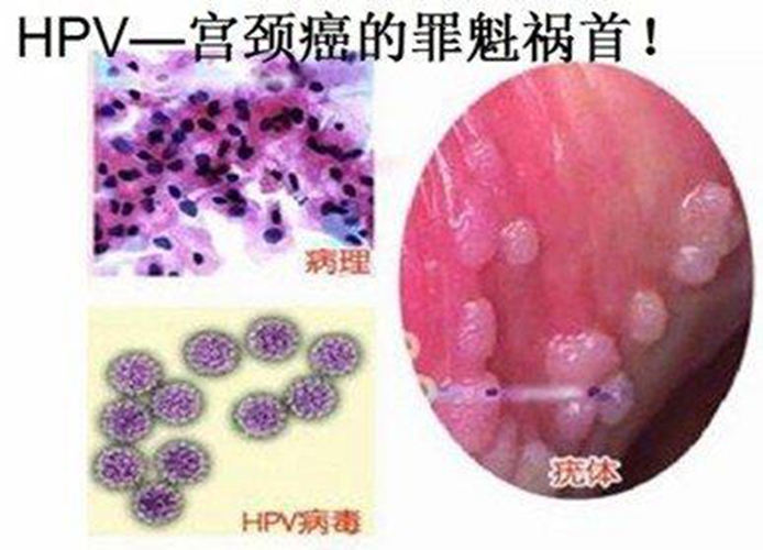 女生殖器疱疹病毒图片
