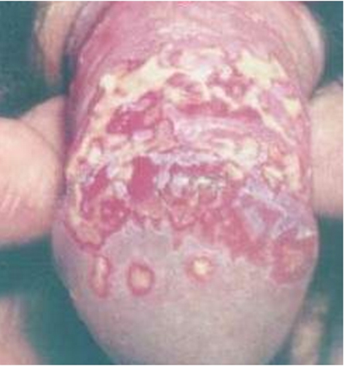 生殖器疱疹红斑图片
