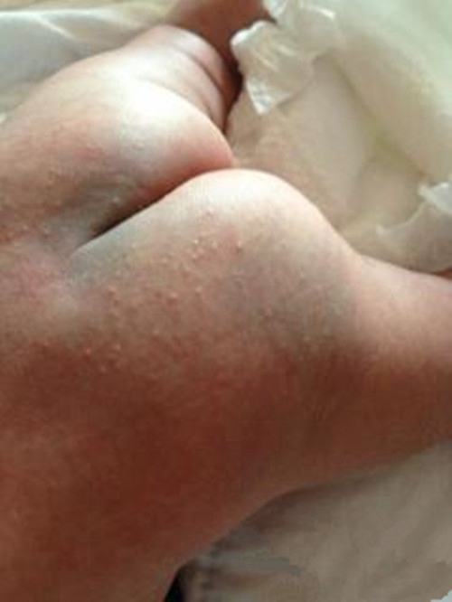 4个月婴儿荨麻疹图片图片