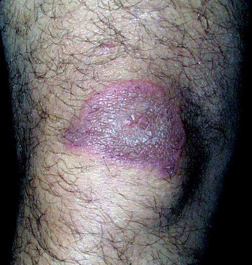 膝盖环形红斑图片