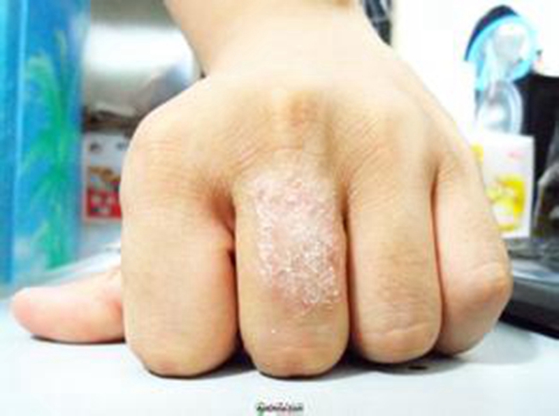 手部脂溢性皮炎初期患者