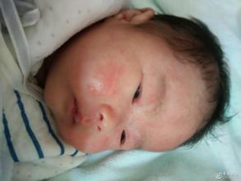 新生儿全脸脂溢性皮炎照片