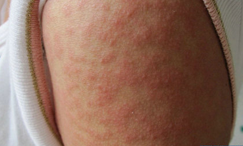 小孩手臂夏季皮炎症状图片
