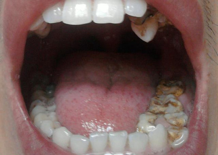 牙齿的虫子好恶心图片图片