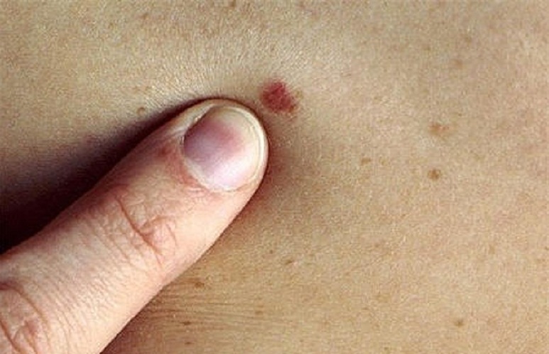 皮肤癌的常见症状图片