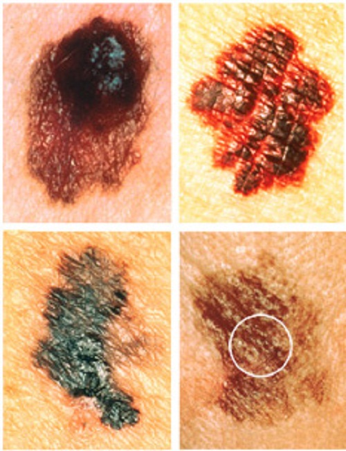 皮肤癌的各种图片