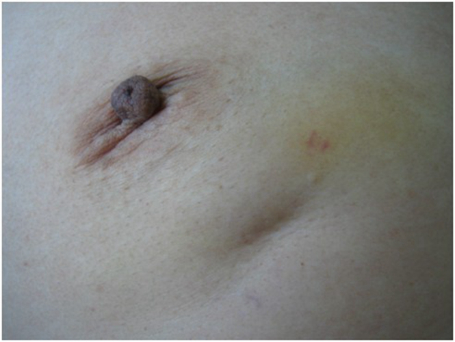 乳腺癌乳头萎缩图片