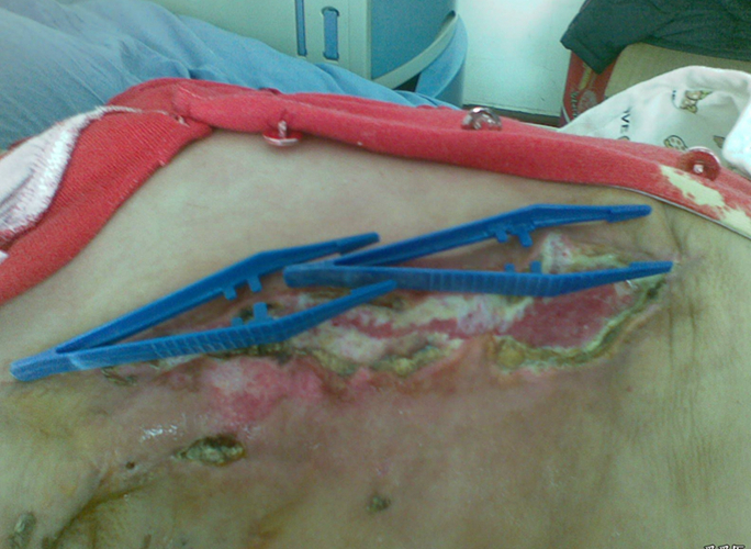 乳腺癌手术后伤口开裂图片