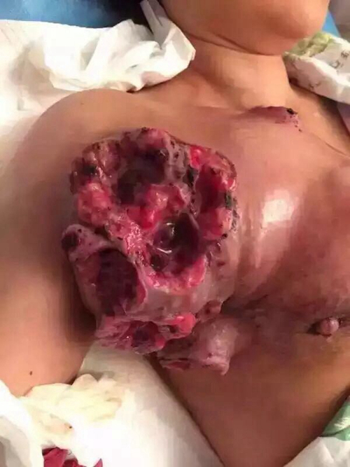 乳腺癌晚期溃烂非常严重图片