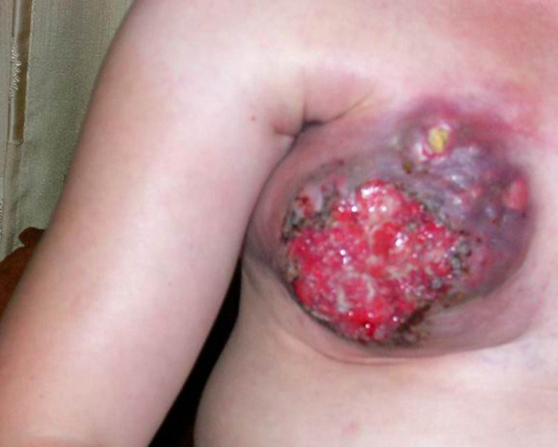 乳腺癌晚期严重溃烂图片