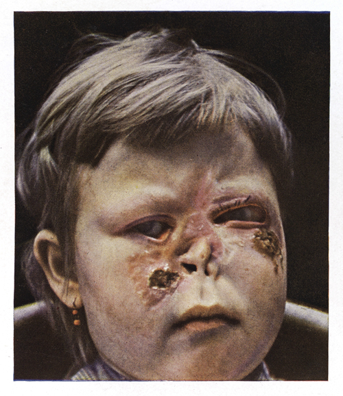 三期梅毒面部女性图片