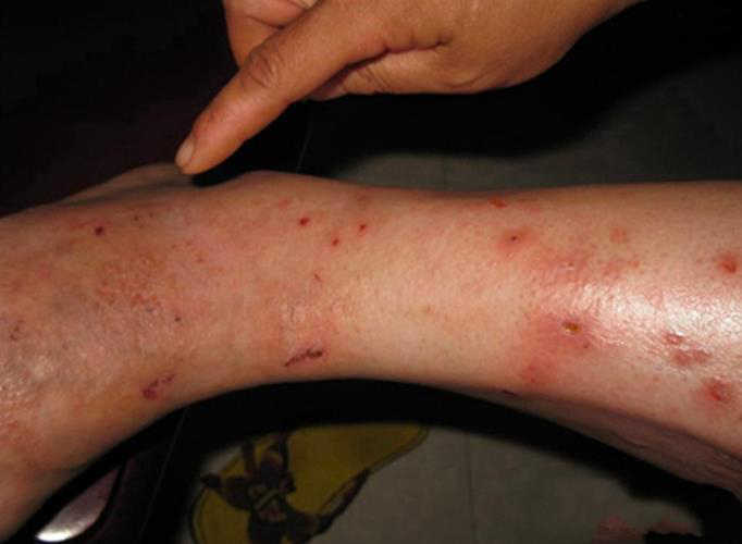 湿疹梅花斑癣图片图片