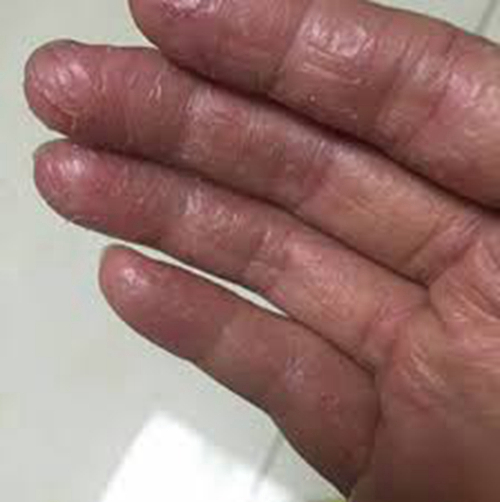 女性干燥手部湿疹症状和图片
