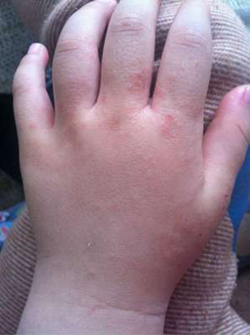 手手部湿疹的图片