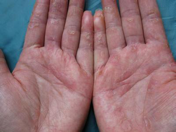 手部湿疹及治疗图片