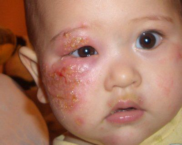 幼儿脸部皮肤病症状图片