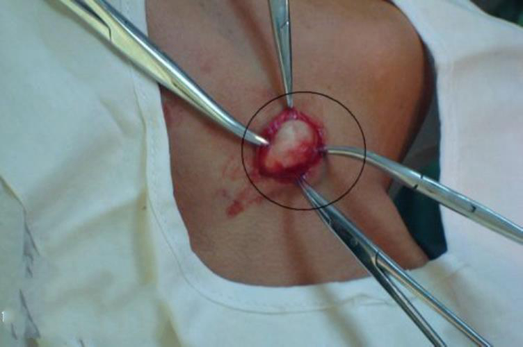 粉瘤手术图片图片