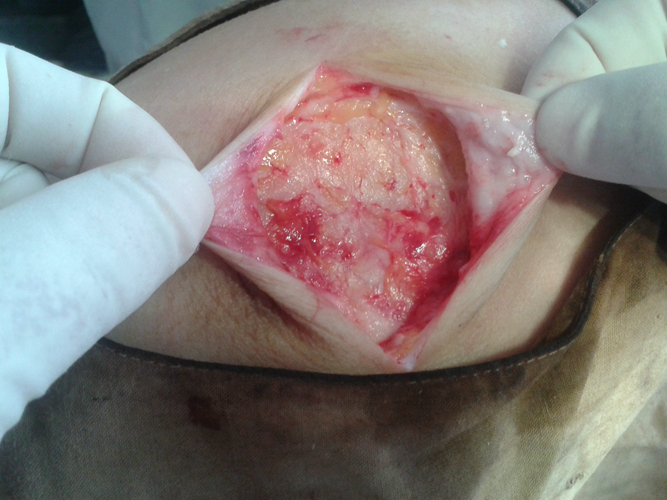 皮脂腺囊肿手术切口