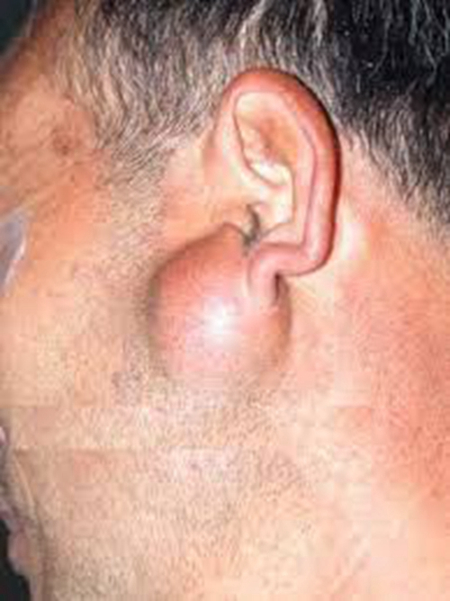耳甲腔皮脂腺囊肿图片图片