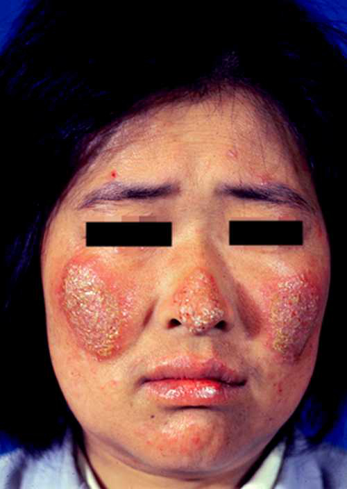 盘型系统性红斑狼疮性面部症状图