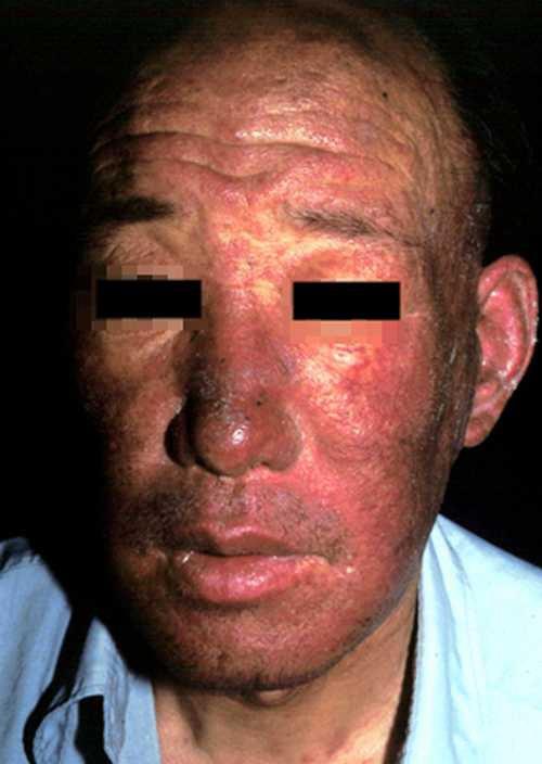 系统性红斑狼疮男性面部症状图