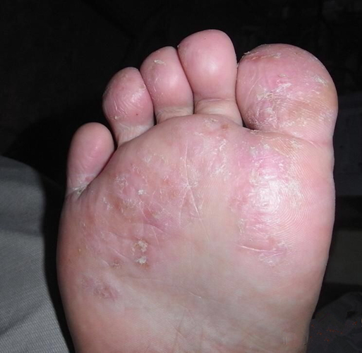 脚气早期症状图片