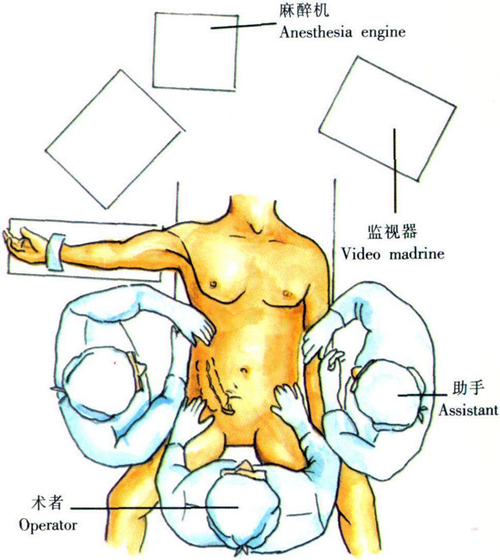 慢性阑尾炎术中操作台全局图片