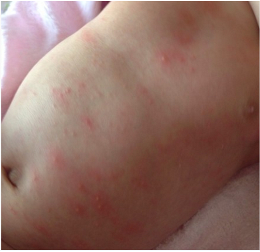 过敏和幼儿急疹的图片图片