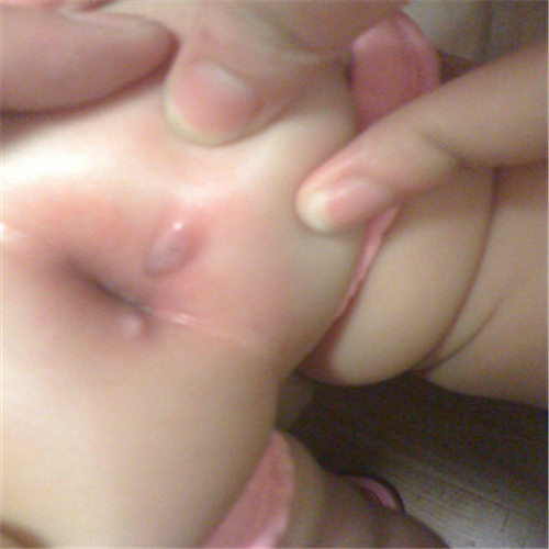 婴儿肛周脓肿轻度图片