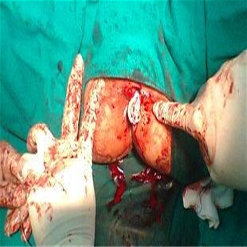 肛周脓肿二次手术图片
