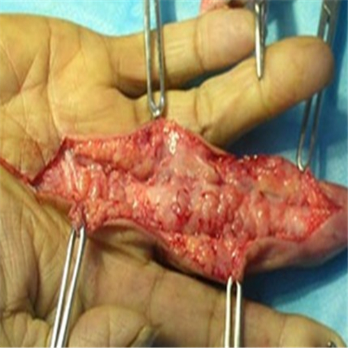 手指腱鞘囊肿手术图片