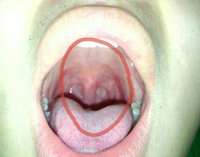 喉咙正常图片图片