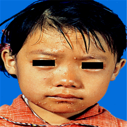 性病传染性软疣儿童图片