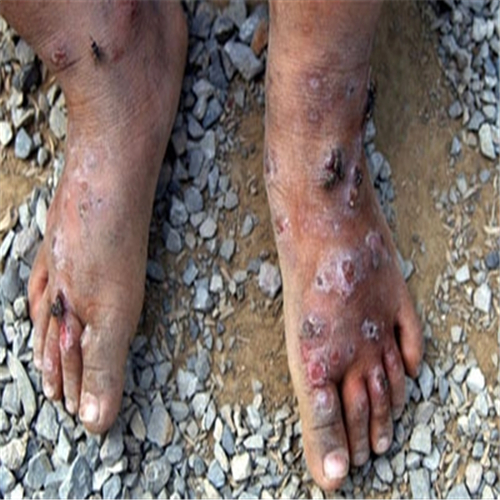 艾滋病脚上症状图片图片