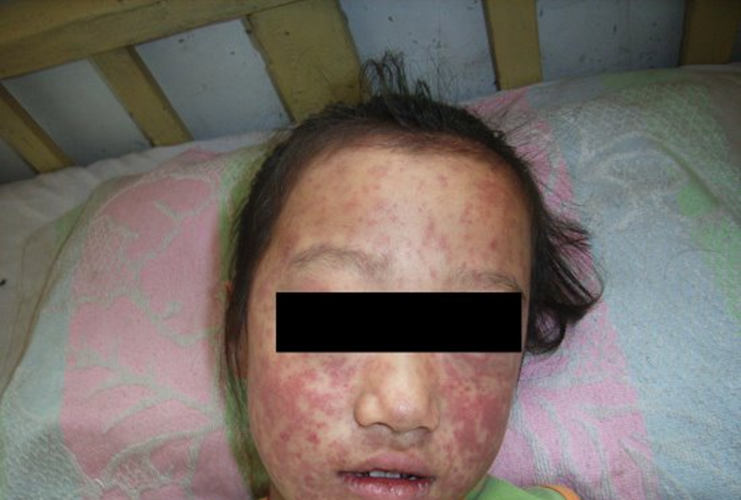 大人麻疹的症状和图片图片