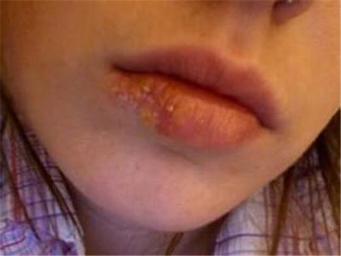 儿童嘴唇内侧单纯性疱疹严重症状图片