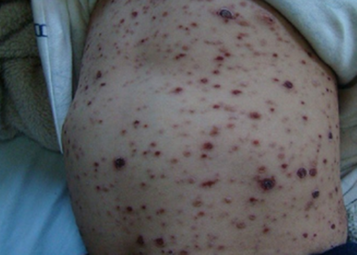 非常严重的麻疹的图片