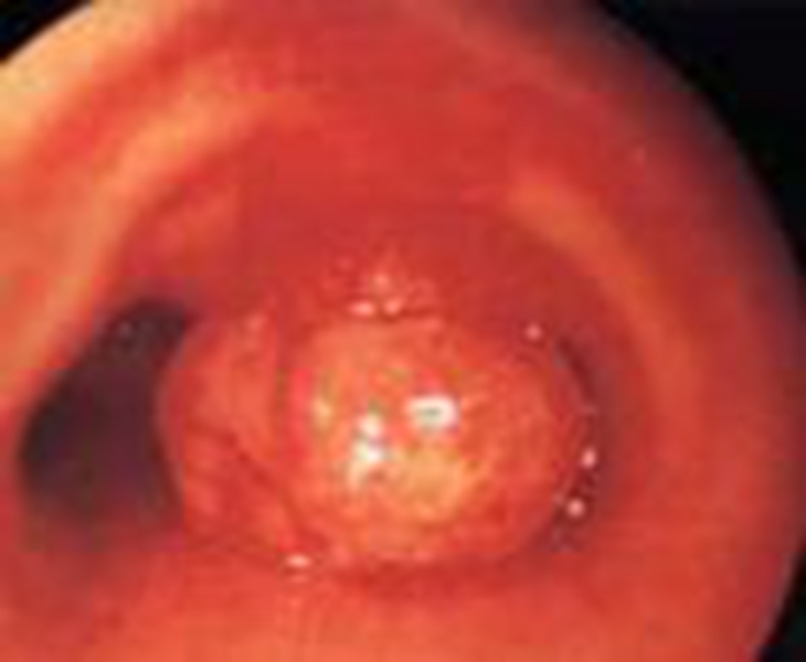喉咙血管瘤图片