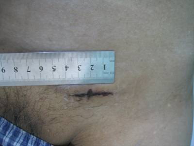 白线疝术后疤痕图片