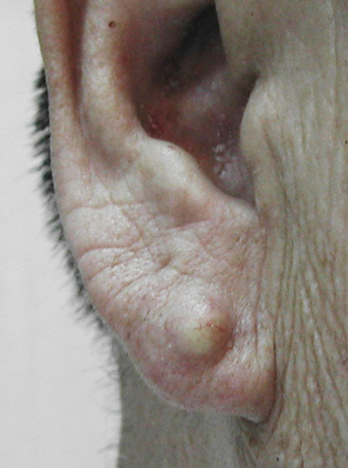 耳朵旁边粉瘤图片图片