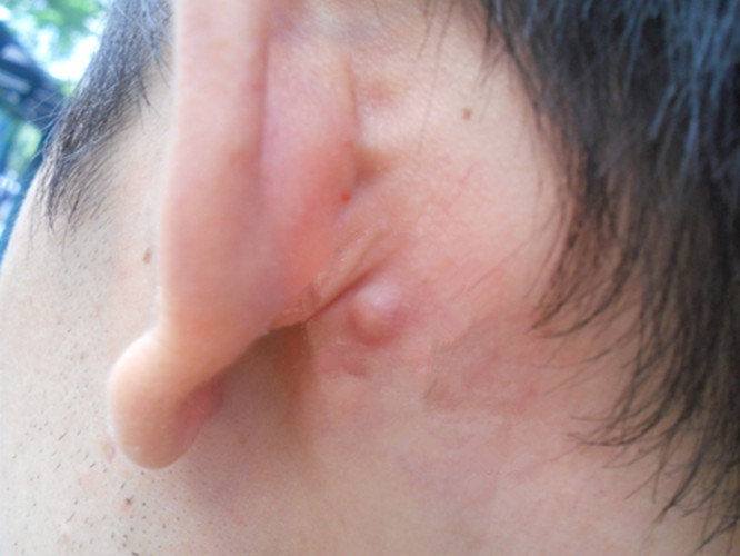 耳朵后边的皮脂腺囊肿图片