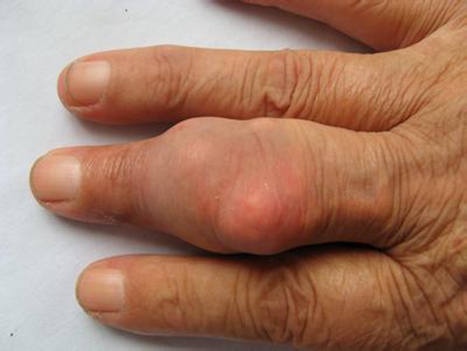 手指痛风症状图片