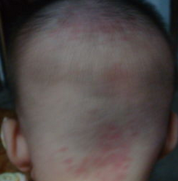 婴儿后脑勺红胎记图片图片
