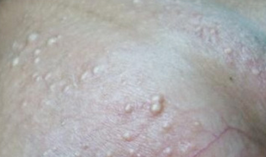 阴囊湿疹初期症状图片
