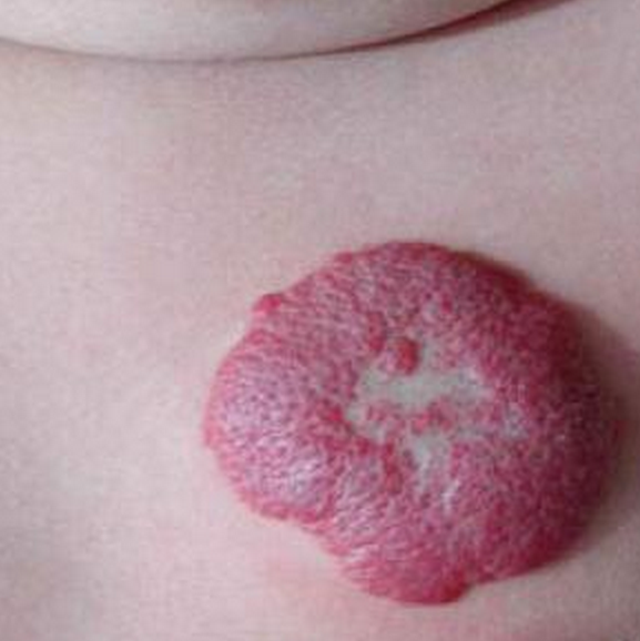 鲜红斑痣血管瘤图片